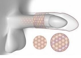 Aumento del pene in volume