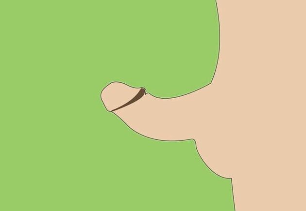 Curvatura del pene come indicazione all'ingrandimento chirurgico